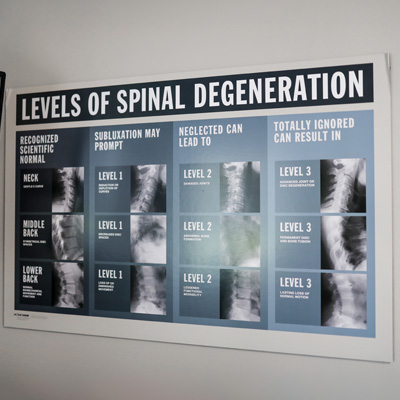 Chiropractic Columbus OH Level of Spinal Degeneration Chiropractic Columbus OH Level of Spinal Degeneration